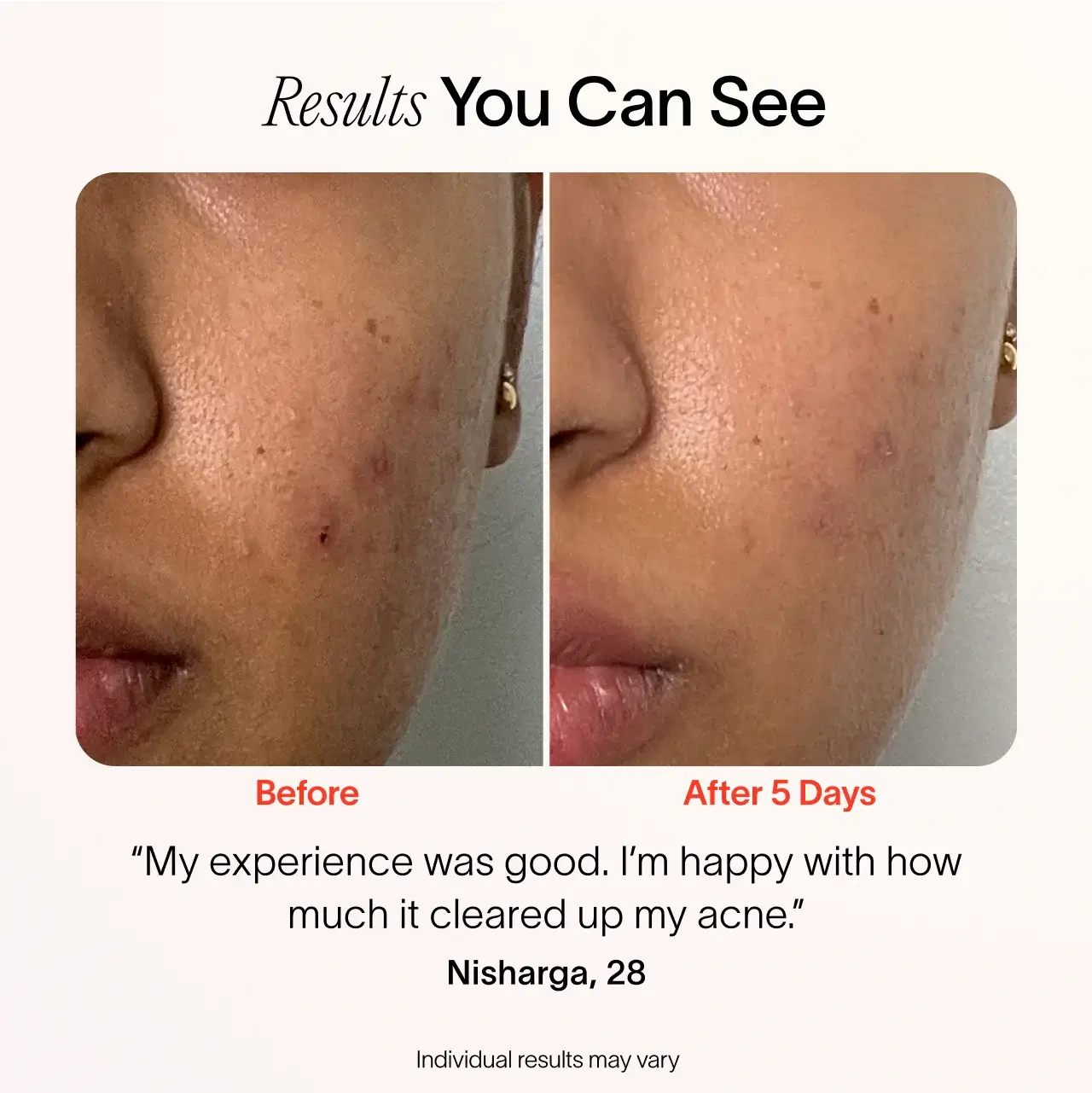 Solawave Bye Acne: 3-Minute Pimple Spot Treatment - Image 14