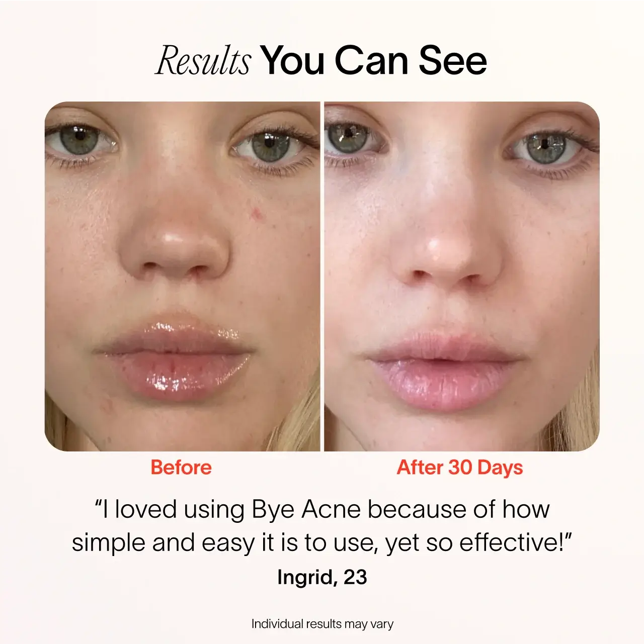Solawave Bye Acne: 3-Minute Pimple Spot Treatment - Image 15
