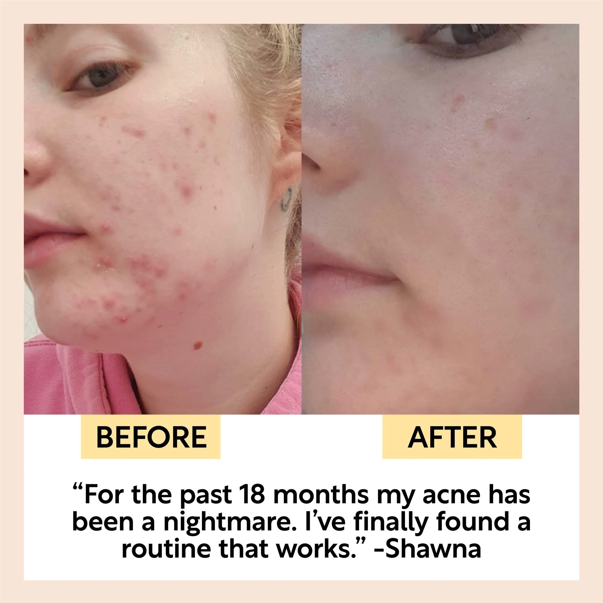 UpCircle The Acne-Prone Bundle - Image 8